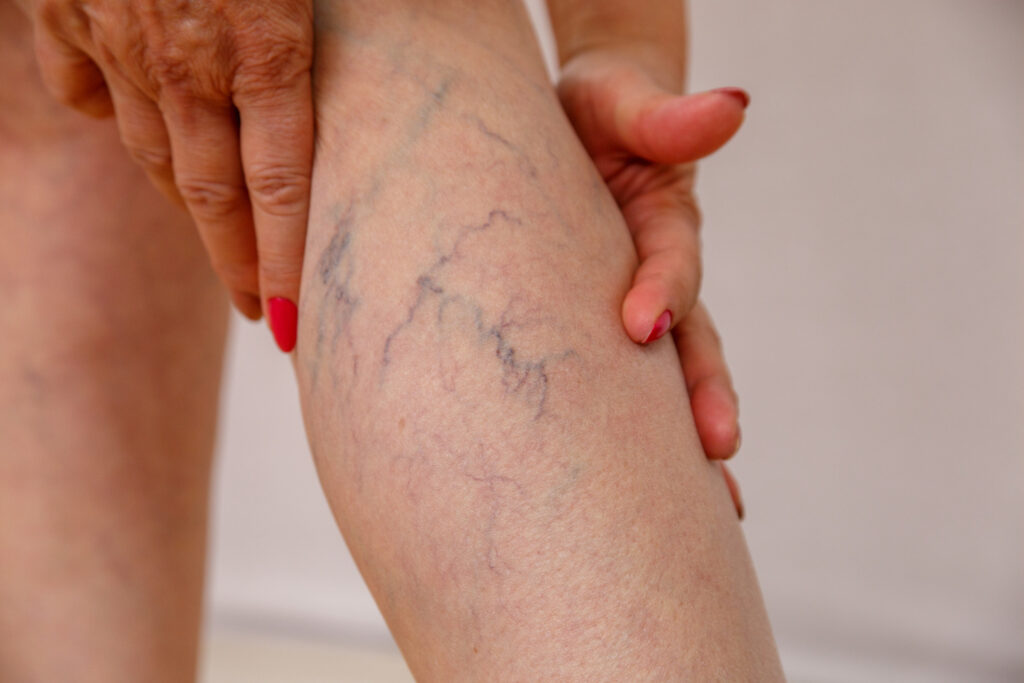 traitement de varices st-jean